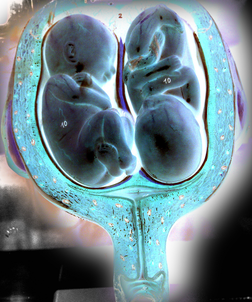 Genetic similarity and prenatal development; both have an effect.